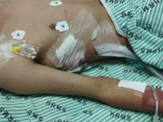 Jovem perde parte do pulmão por usar vape e narguile em MS